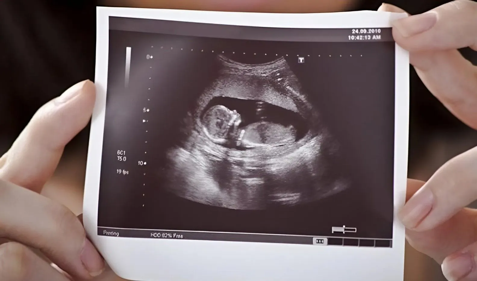 Жителі Полтавщини можуть безплатно лікувати безпліддя та завагітніти через ЕКЗ