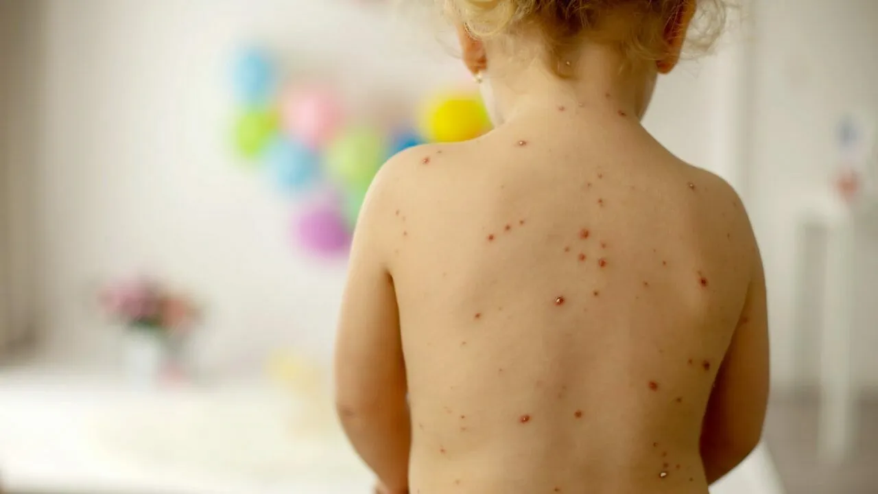 У Пирятинській тергромаді вісім дітей захворіли на кір