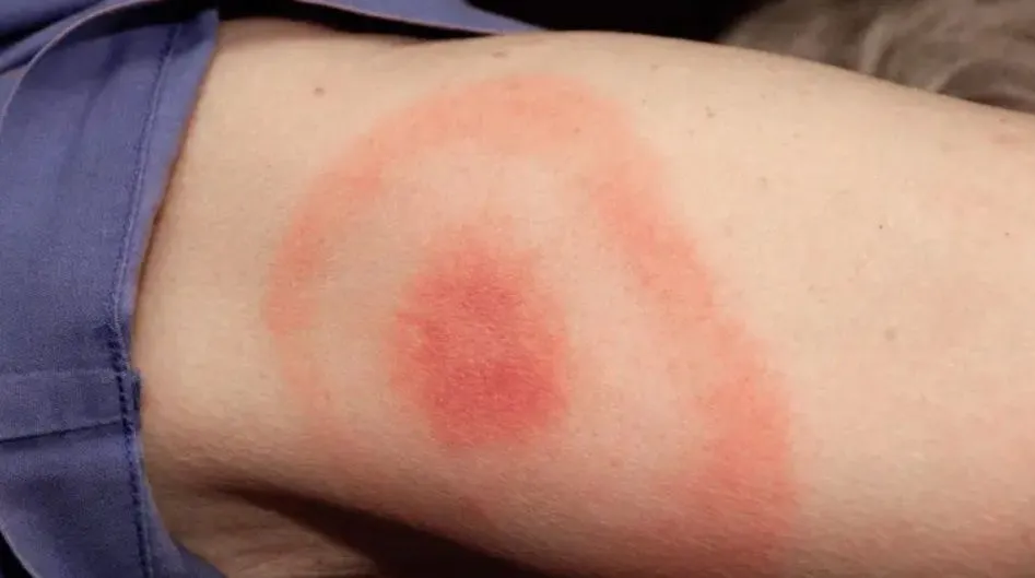 У Полтавській області перевищений багаторічний показник випадків хвороби Лайма