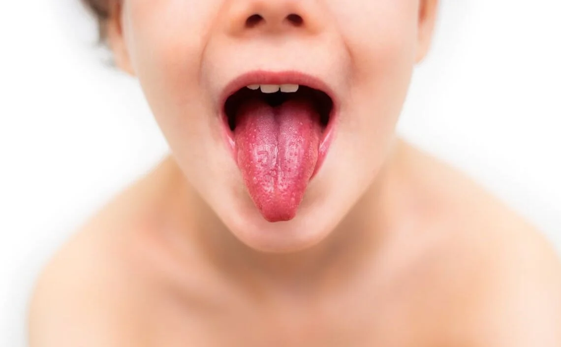 На Полтавщині зросла захворюваність на скарлатину