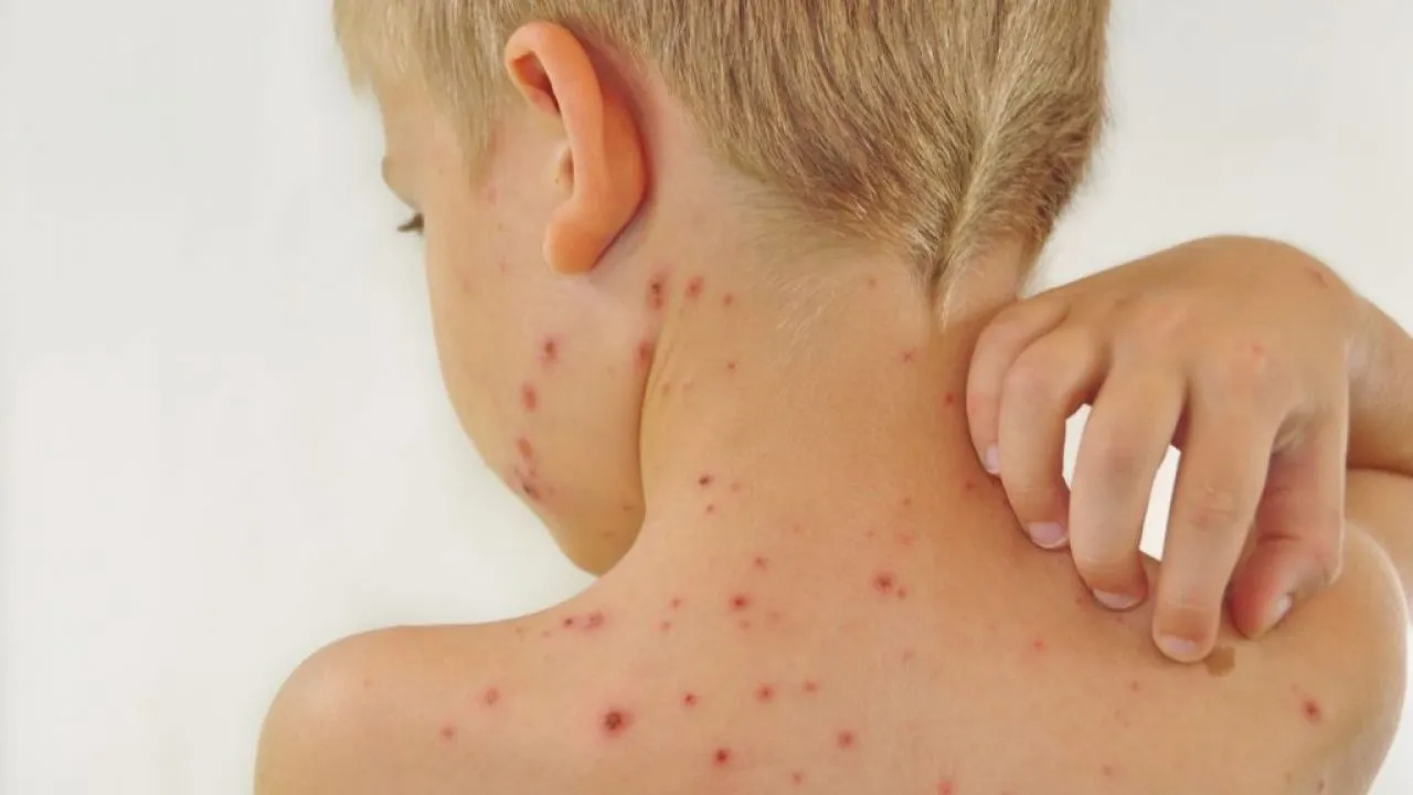 У Полтавській області зросла захворюваність на вітряну віспу