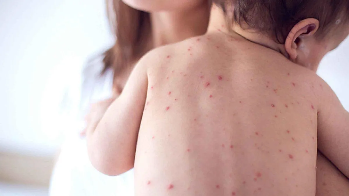 На Полтавщині зростає захворюваність на вітряну віспу