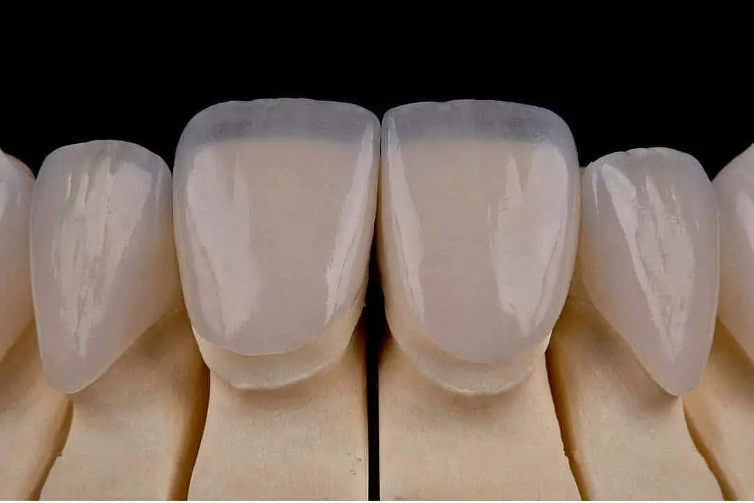 Чому керамічні вініри виглядають природніше за інші методи реставрації